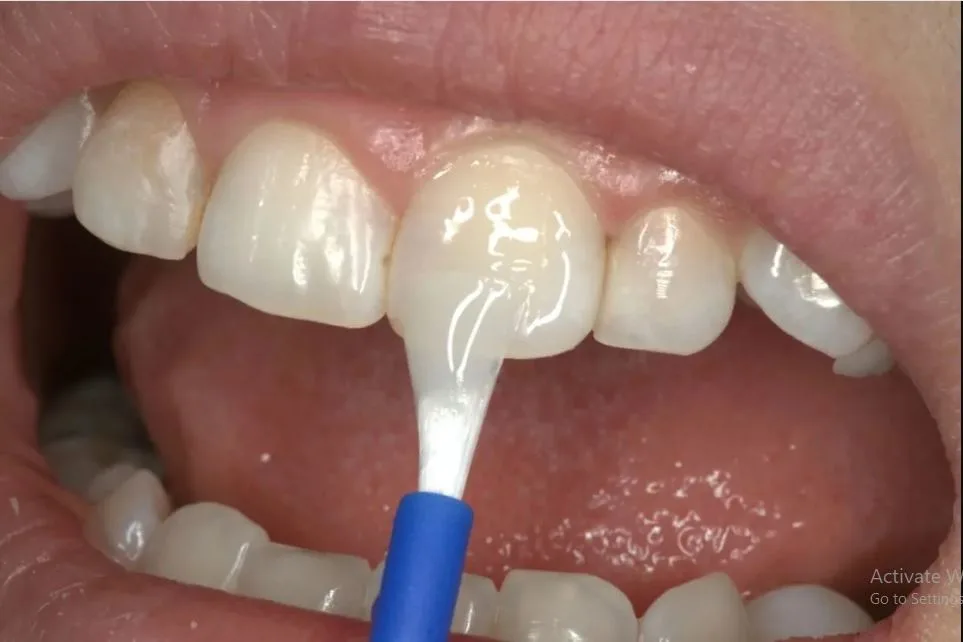 Treatment to Reduce Tooth sensitivity